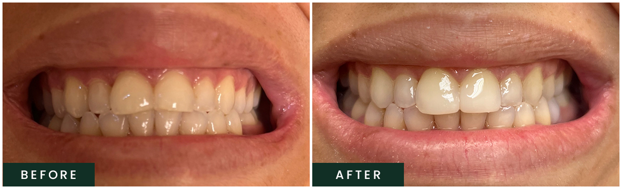 Veneers treatment in Weatherford Before and After Witness the Transformation